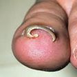 Ingrown toenail (Credit - MedicineNet)