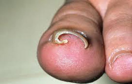 Ingrown toenail (Credit - MedicineNet)