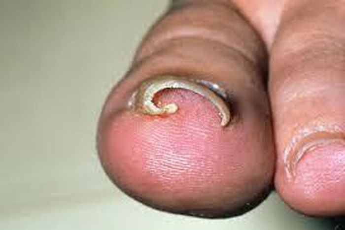 Ingrown toenail (Credit - MedicineNet)