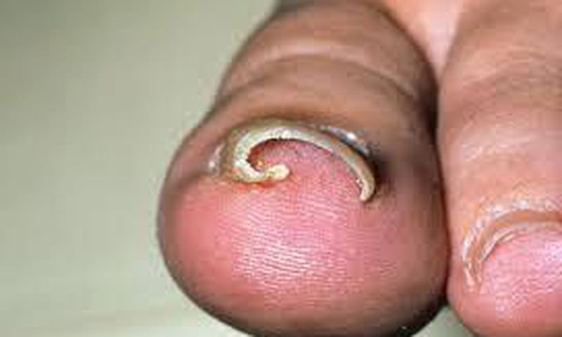 Ingrown toenail (Credit - MedicineNet)