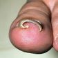Ingrown toenail (Credit - MedicineNet)