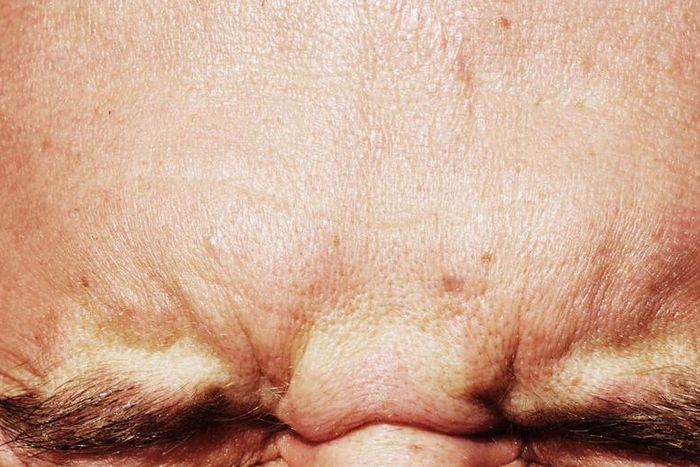 Dr. Pimple Popper Clears Forehead Of Blackheads