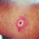 Do You Have A Spider Bite? These 7 Photos Can Help You Tell