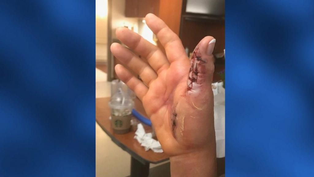 Woman Contracts Flesh-Eating Bacteria At Salon