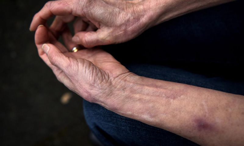 At 71, She's Never Felt Pain or Anxiety. Now Scientists Know Why.