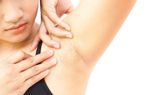 Dr. Pimple Popper Extracts Eruptive Cysts
