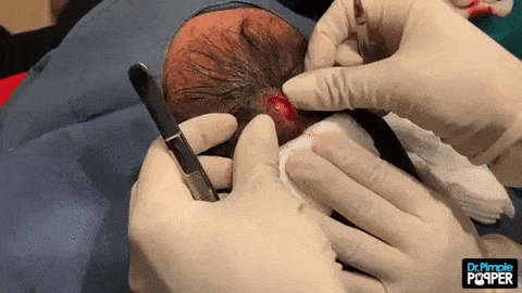 Dr. Pimple Popper Extracts A Pilar Cyst