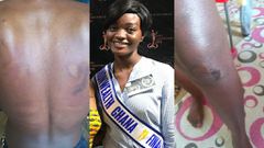 Nana Ama Essien's scars from the shrine brutality