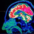 A new study honed in on the brain circuitry responsible for upgrading or downgrading pain signals, likening the mechanism to how a home thermostat controls room temperature