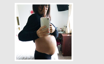 Not Pregnant: Woman Discovers Huge Ovarian Tumors