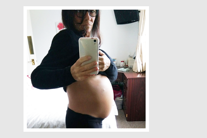 Not Pregnant: Woman Discovers Huge Ovarian Tumors