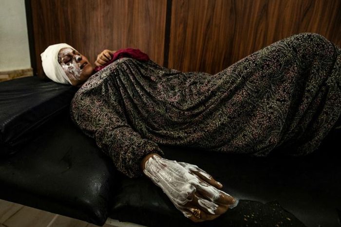 Syrian patient Fatima al-Issa who was hit by shrapnel during Turkish bombardment of Ras al-Ain, rests after receiving treatment at a hospital in the town of Tal Tamr in the countryside of Syria's northeastern Hasakeh province, on October 11, 2019.Ankar...