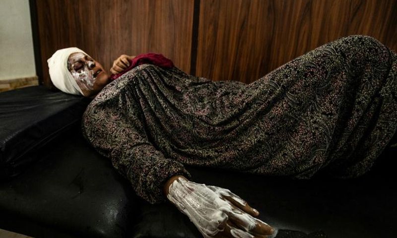 Syrian patient Fatima al-Issa who was hit by shrapnel during Turkish bombardment of Ras al-Ain, rests after receiving treatment at a hospital in the town of Tal Tamr in the countryside of Syria's northeastern Hasakeh province, on October 11, 2019.Ankar...