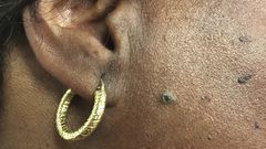 Dr. Pimple Popper Pops A 'Sticky' DPOW