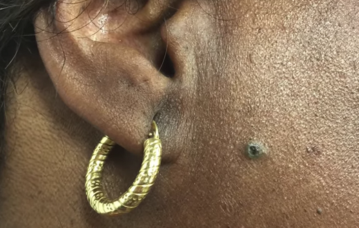 Dr. Pimple Popper Pops A 'Sticky' DPOW
