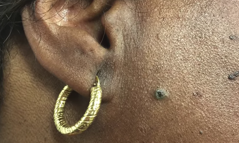 Dr. Pimple Popper Pops A 'Sticky' DPOW