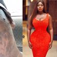 Princess Shyngle finds a cure to her acne disaster