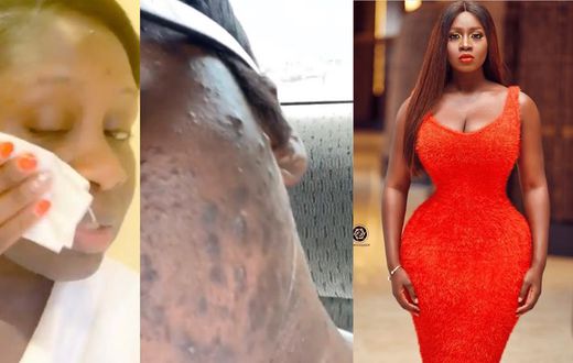 Princess Shyngle finds a cure to her acne disaster