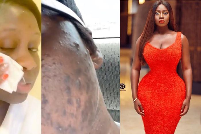 Princess Shyngle finds a cure to her acne disaster