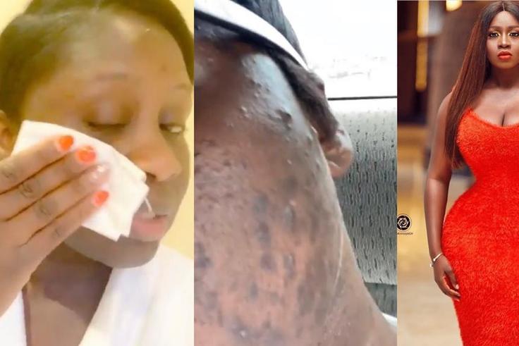 Princess Shyngle finds a cure to her acne disaster