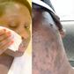 Princess Shyngle finds a cure to her acne disaster