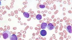 Would You Be Able To Spot These 7 Symptoms Of Leukemia?