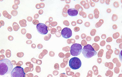 Would You Be Able To Spot These 7 Symptoms Of Leukemia?
