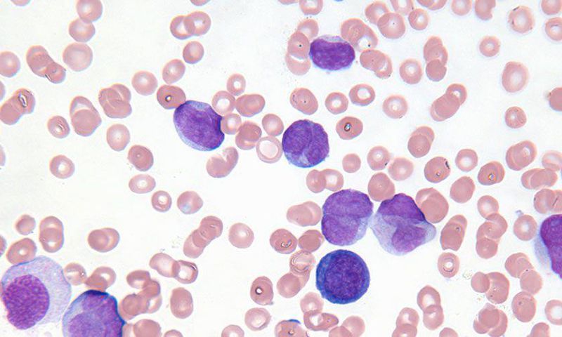 Would You Be Able To Spot These 7 Symptoms Of Leukemia?