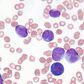 Would You Be Able To Spot These 7 Symptoms Of Leukemia?