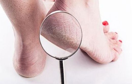 Cracked heels