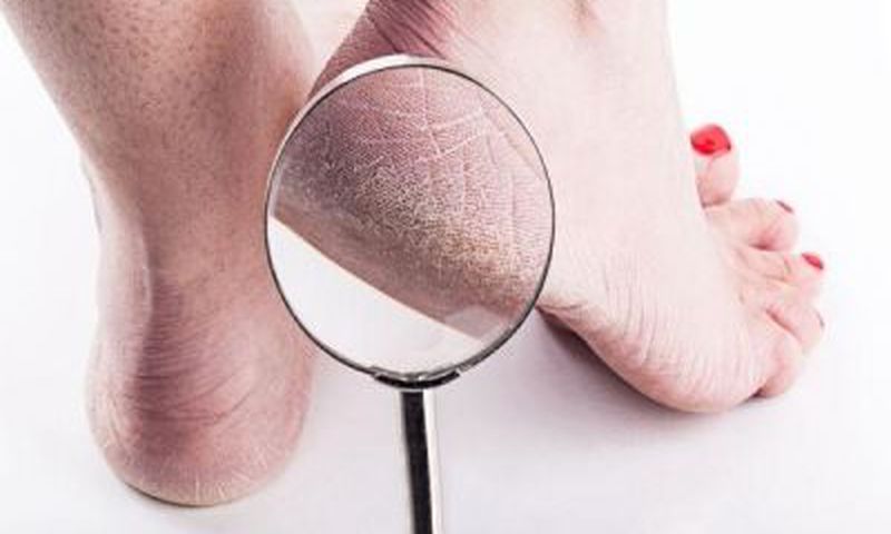 Cracked heels
