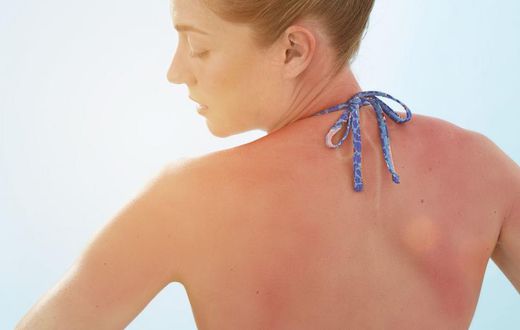 These Photos Show What Sun Poisoning Look Like