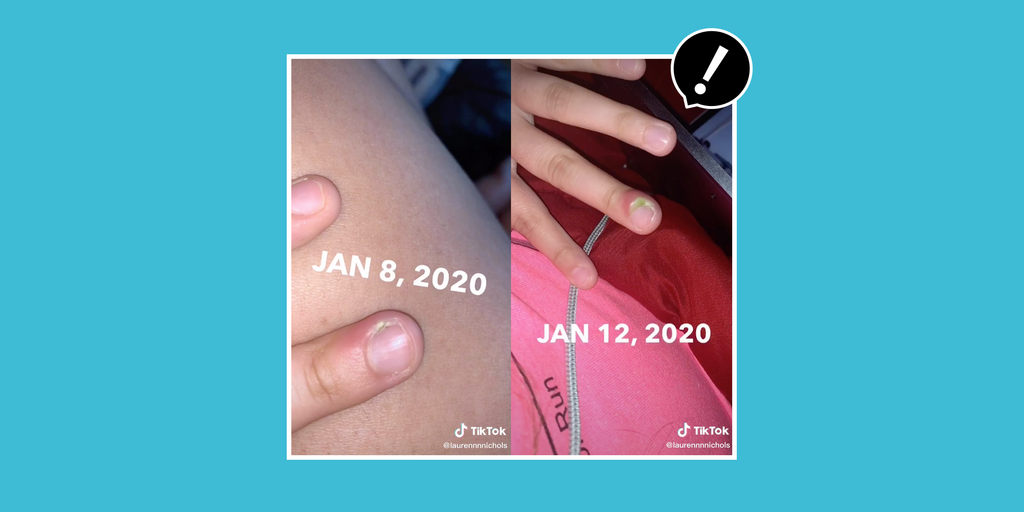 A Teen Warns Against Nail Biting After Almost Losing Her Fingertip Due