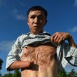 Vietnamese landmine victim Nguyen The Nghia in January 2020 shows his wounds caused by a munitions explosion when he was younger in Quang Tri province