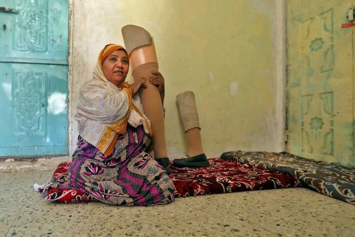 Jamila Qassem Mahyoub, a Yemeni woman whose legs were amputated after stepping on a landmine while herding her sheep in 2017, holds a prosthetic leg in a house in Yemen's third city of Taez on March 20, 2019.