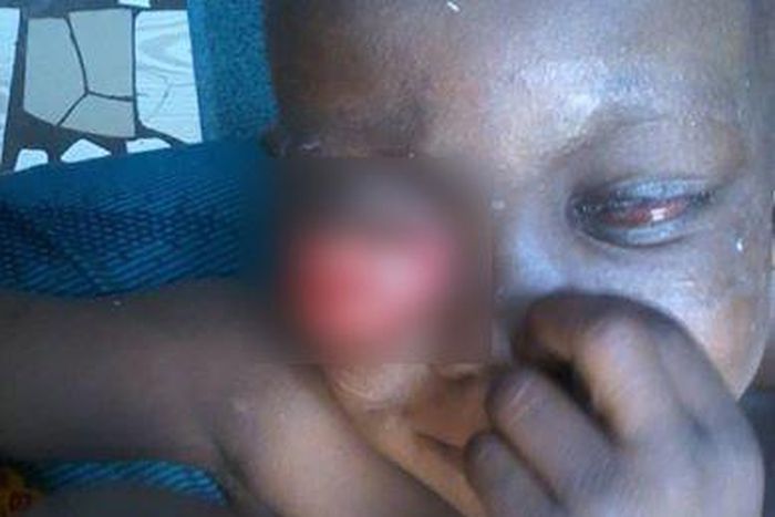 Litle girl Doris battling with eye cancer needs help