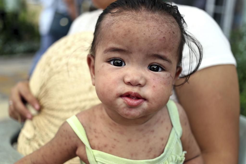 Measles has a see-it-once-and-youll-never-forget it rash.