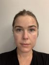 The morning after microneedling.
