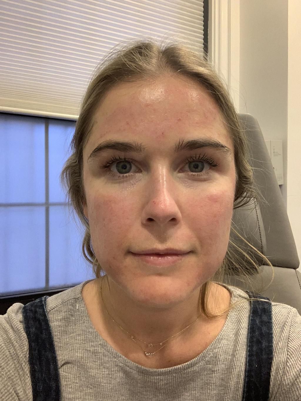Immediately after microneedling (after the blood and serum was wiped away).