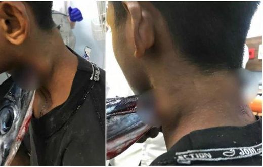 Needlefish stabs boy in the neck injuring him severely