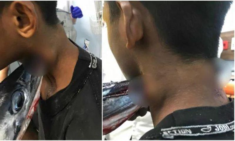 Needlefish stabs boy in the neck injuring him severely