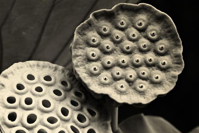 Dr. Pimple Popper Pops a Huge Crusty Blackhead