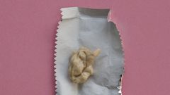 Dr. Pimple Popper Removes a Chewed Gum Lipoma