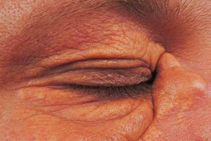 Dr. Pimple Popper Removes a Rare Skin Condition