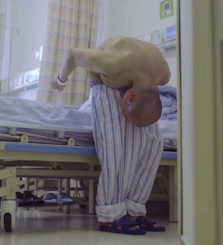 Medical condition makes this man spend 3 decades of his life with his head stuck to his knees