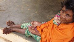 Woman with 31 fingers and toes chooses to live indoors as she’s branded a witch