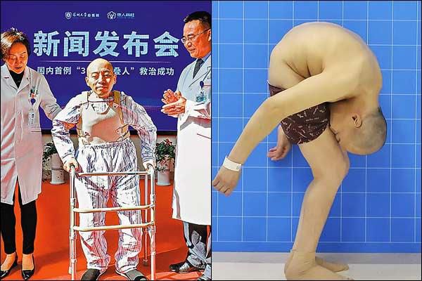 Medical condition makes this man spend 3 decades of his life with his head stuck to his knees
