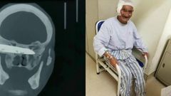 Doctors remove 4-inch-long rusty knife from man’s head 26 years after he was stabbed (photos)