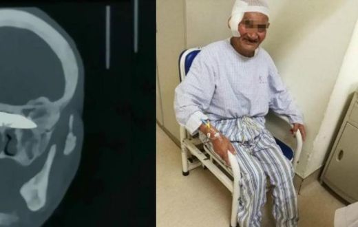 Doctors remove 4-inch-long rusty knife from man’s head 26 years after he was stabbed (photos)