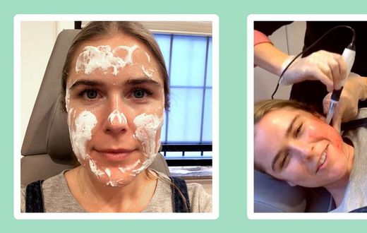 "Microneedling made my skin softer than ever."